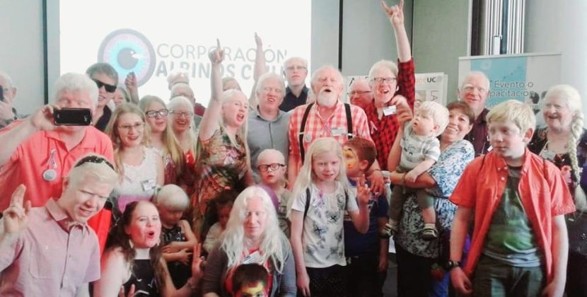 Corporación Albinos Chile busca financiar proyecto de salud mental